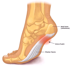 The best shoes for plantar fasciitis